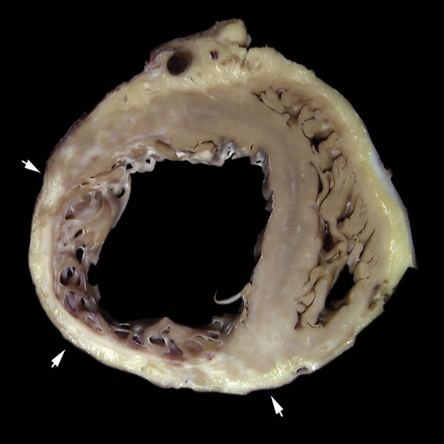 Healed transmural ami